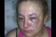 El terrible testimonio de una mujer desfigurada en un asalto en Castelar sur