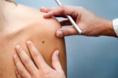 Ituzaingó: Campaña de prevención del cáncer de piel