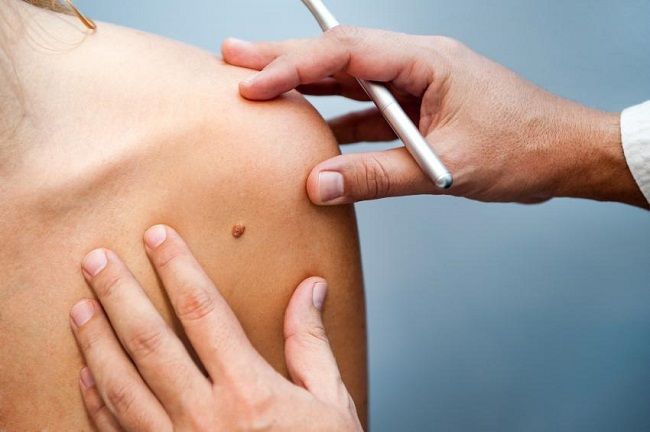 Ituzaingó: Campaña de prevención del cáncer de piel